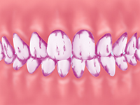 歯垢（歯垢）の染めだし
