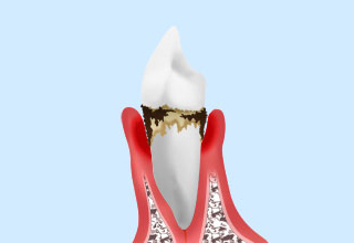 歯周病の治療について